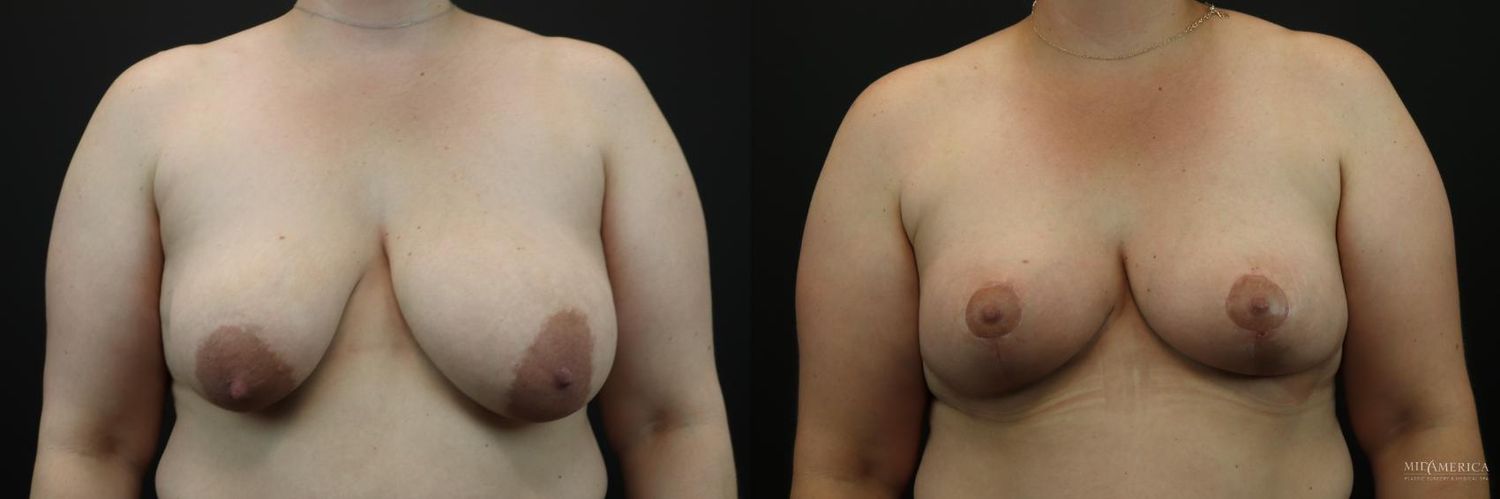 Breast Lift Before & After