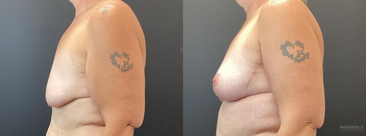 Breast Lift Before & After
