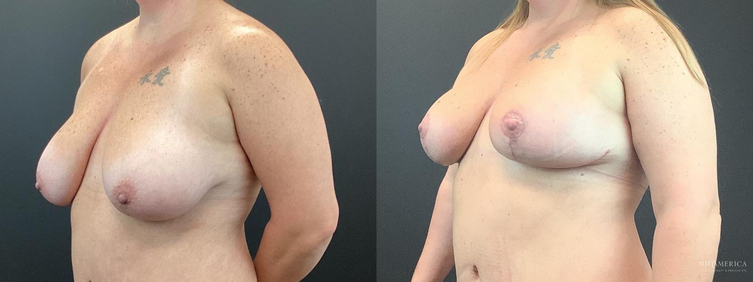 Breast Lift Before & After