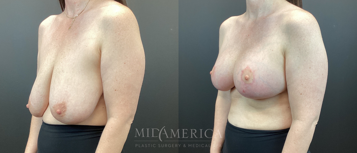 Breast Lift Before & After