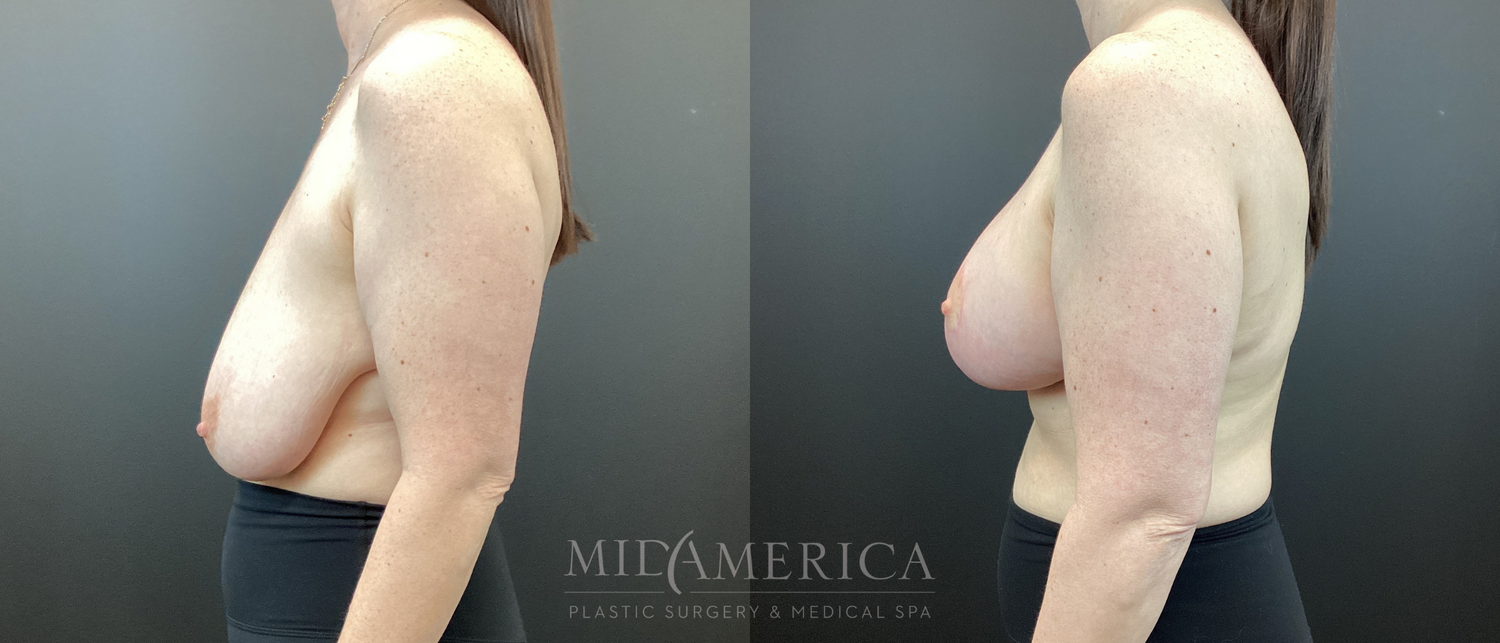 Breast Lift Before & After
