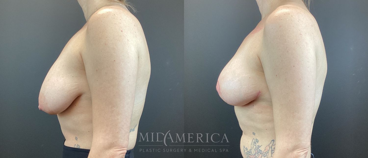 Breast Lift Before & After