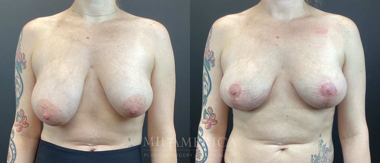Breast Lift Before & After