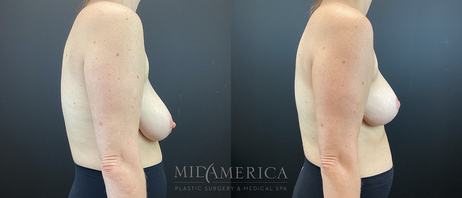 Breast Lift Before & After
