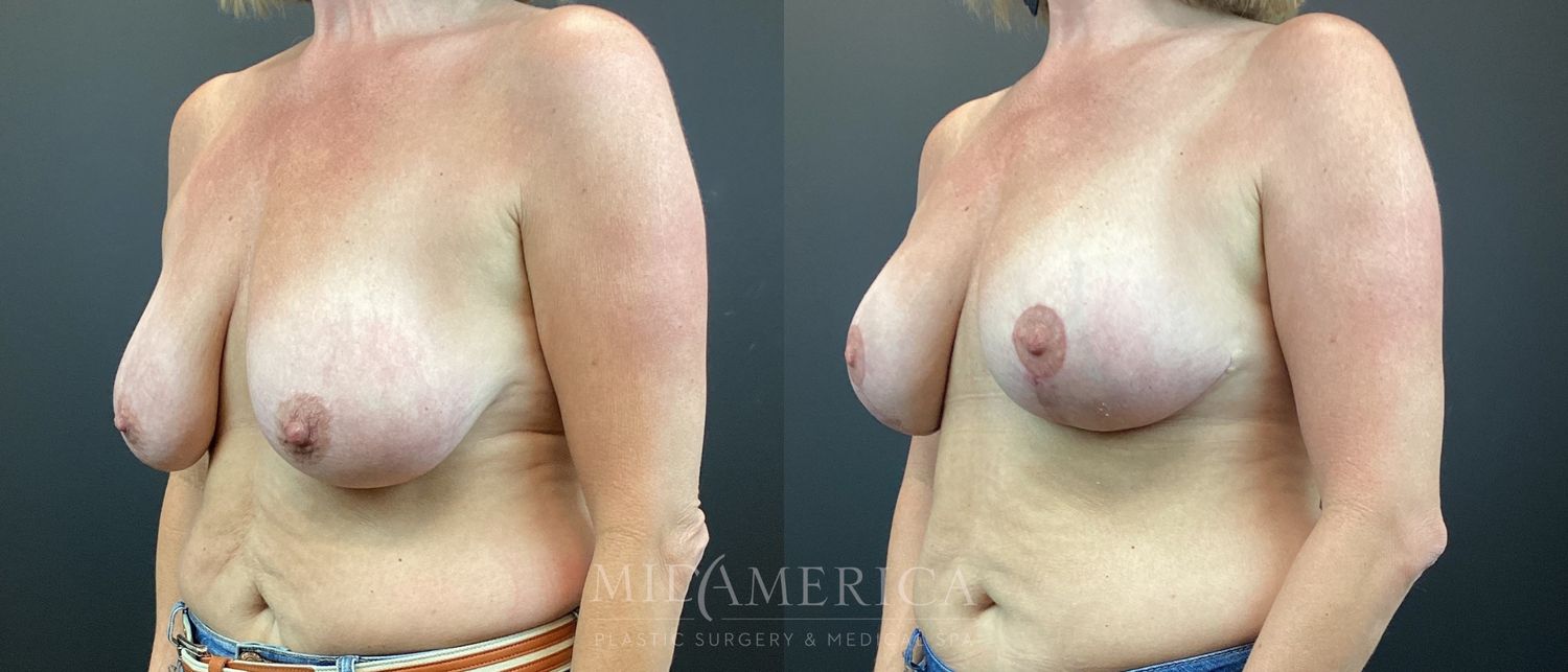 Breast Lift Before & After