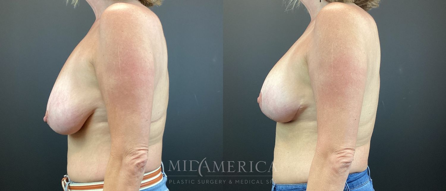 Breast Lift Before & After