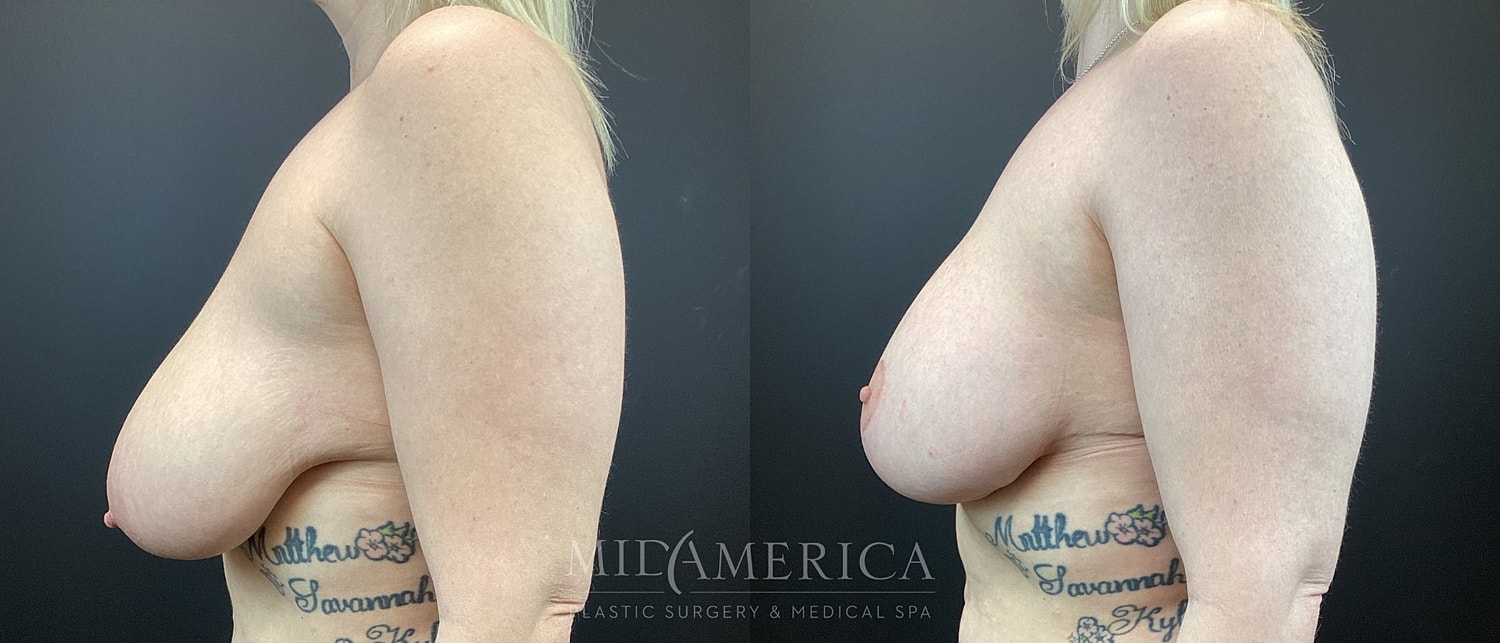 Breast Lift Before & After