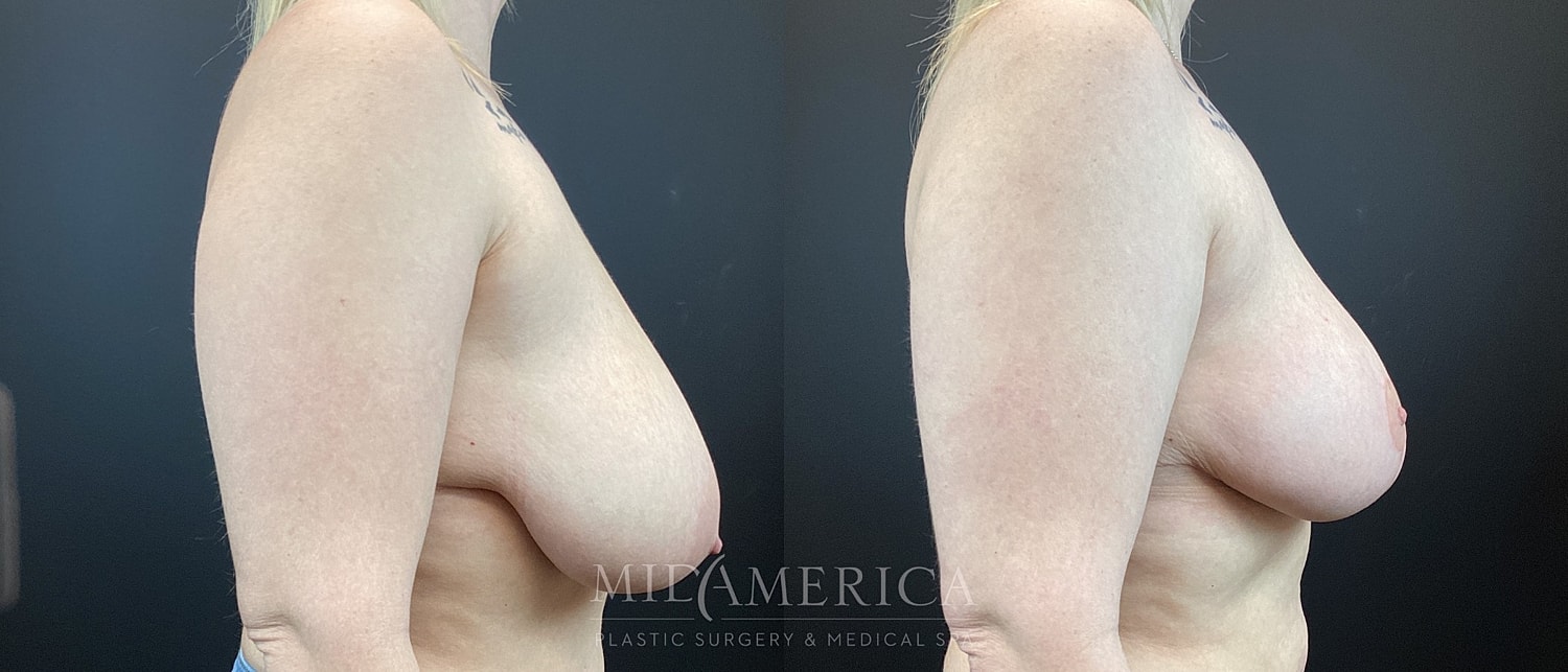 Breast Lift Before & After