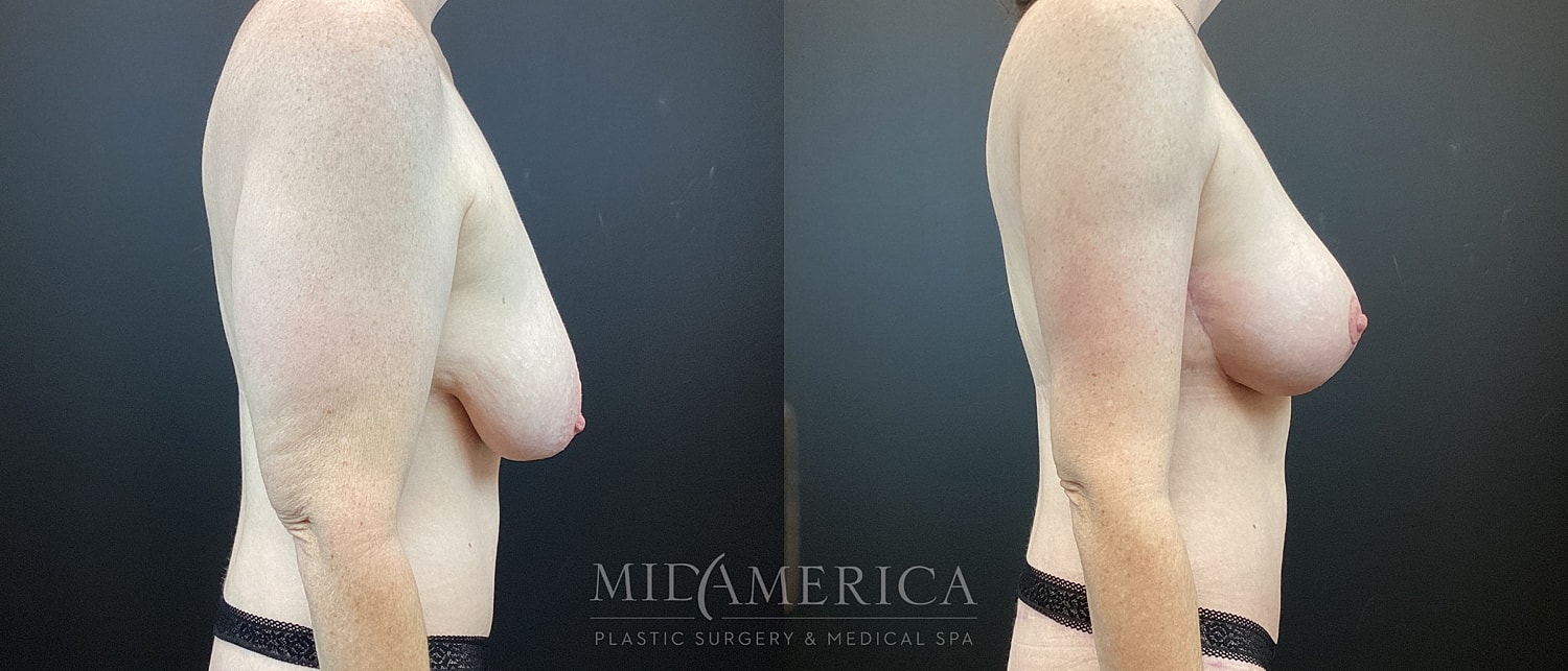 Before and after breast procedure side view.