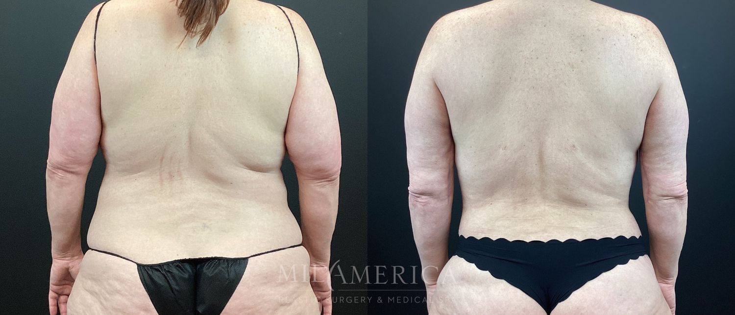Belt Lipectomy  Before & After