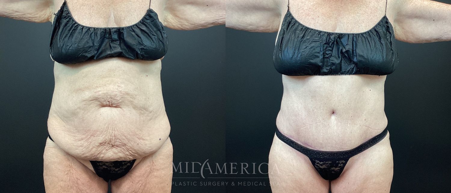 Belt Lipectomy  Before & After