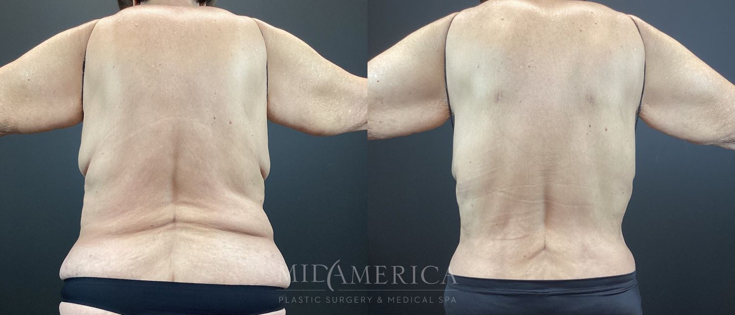 Belt Lipectomy Patient 6453 before & afters | MidAmerica
