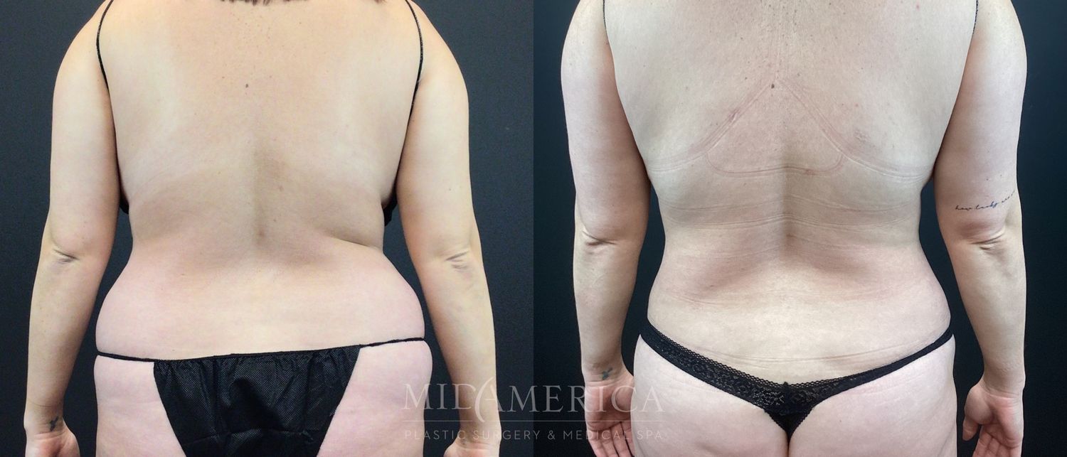 Belt Lipectomy  Before & After
