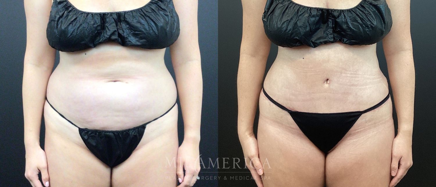 Belt Lipectomy  Before & After