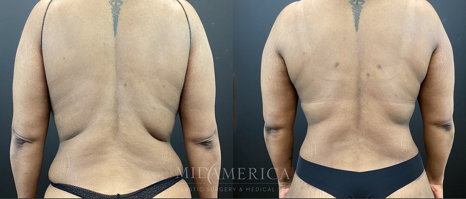 Belt Lipectomy  Before & After