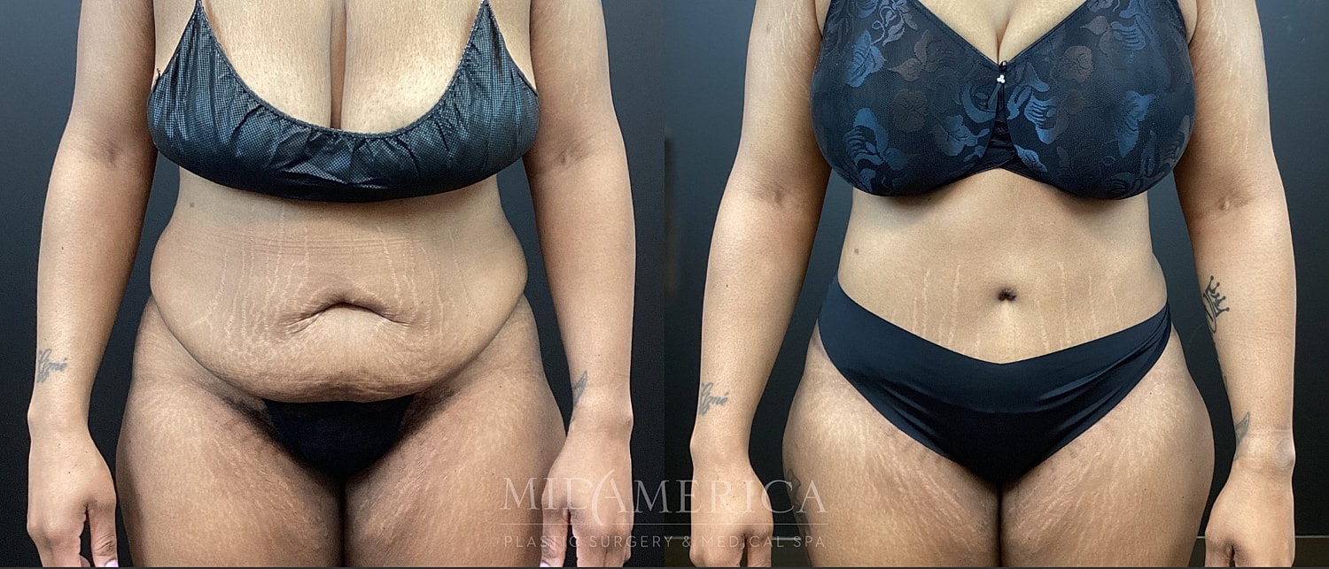 Belt Lipectomy  Before & After