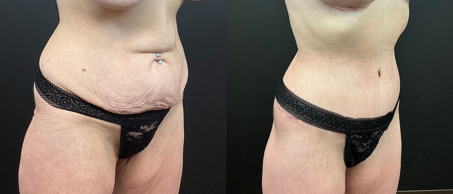 Belt Lipectomy  Before & After
