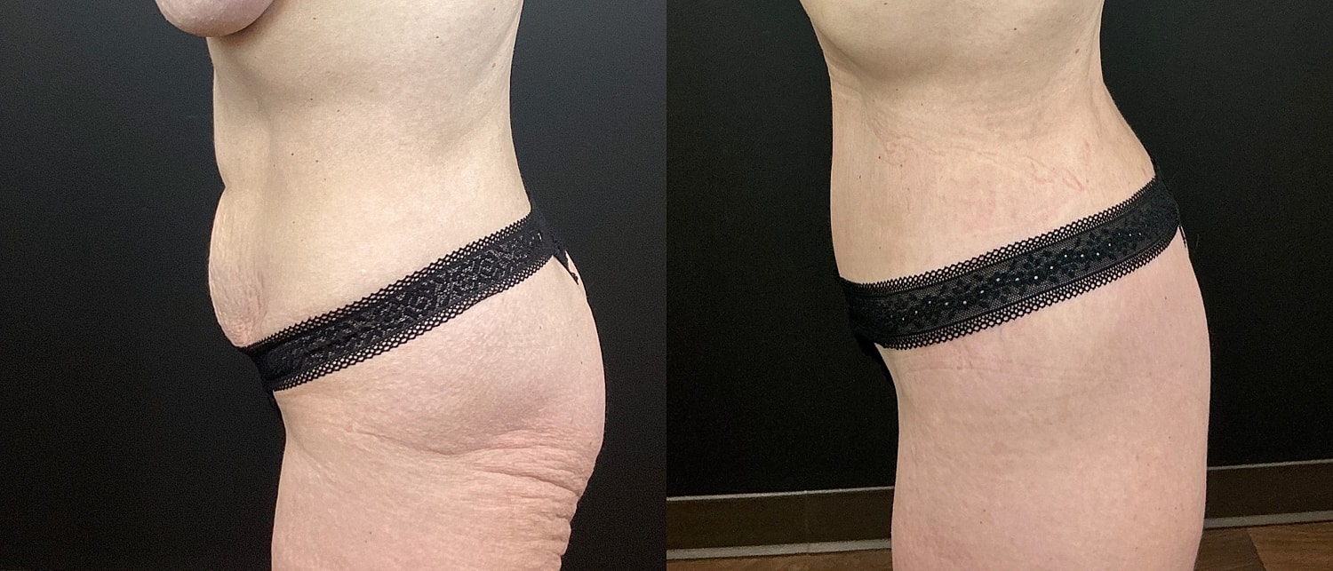 Belt Lipectomy  Before & After