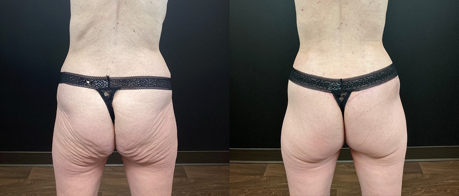 Belt Lipectomy  Before & After