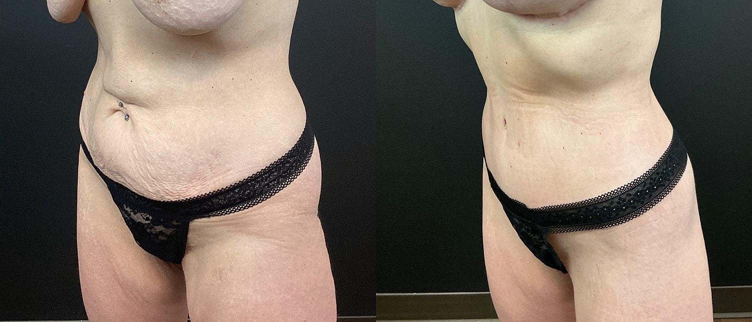 Belt Lipectomy  Before & After