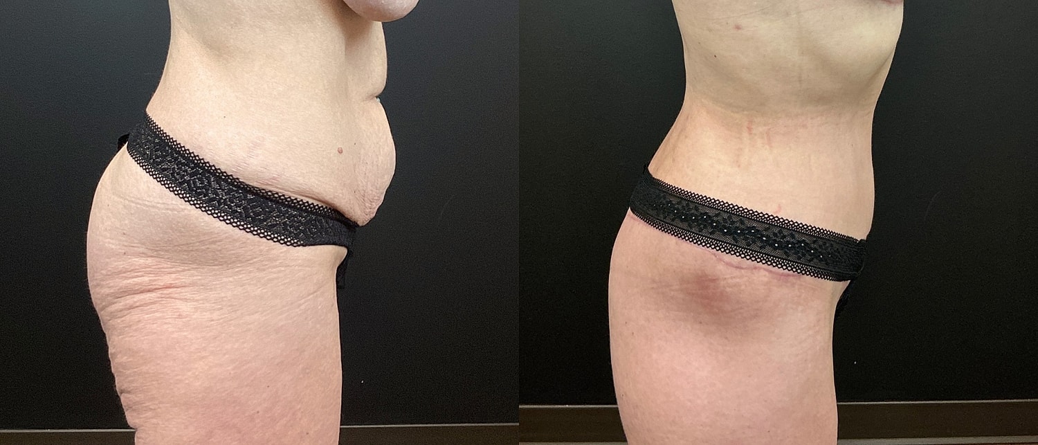Belt Lipectomy  Before & After
