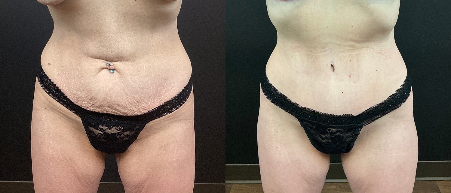 Belt Lipectomy  Before & After