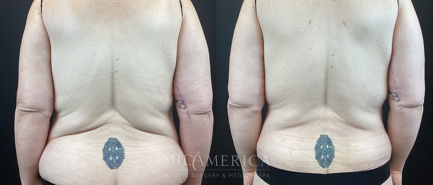Before and after body contouring surgery comparison.