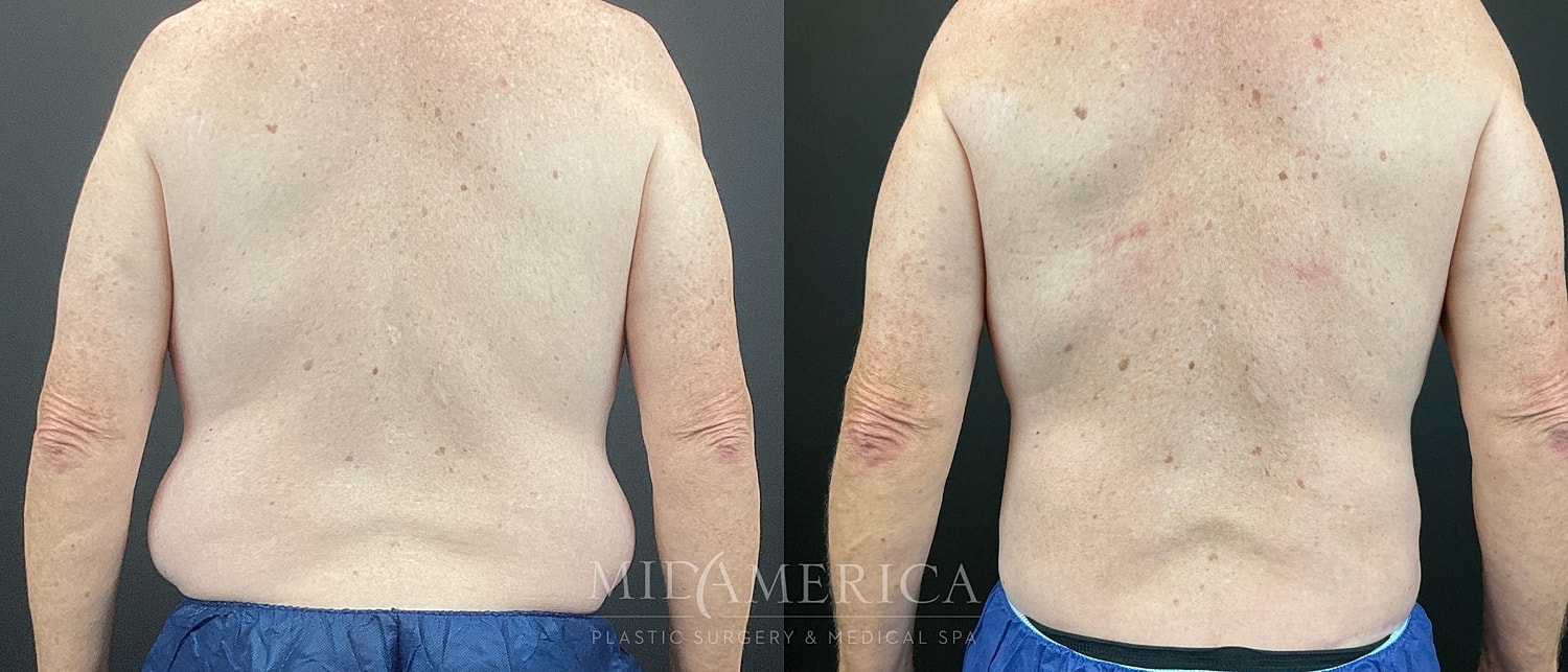 Belt Lipectomy  Before & After