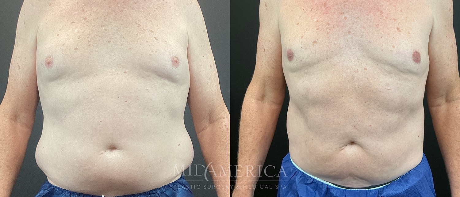 Belt Lipectomy  Before & After