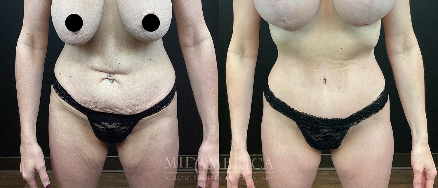 Belt Lipectomy  Before & After