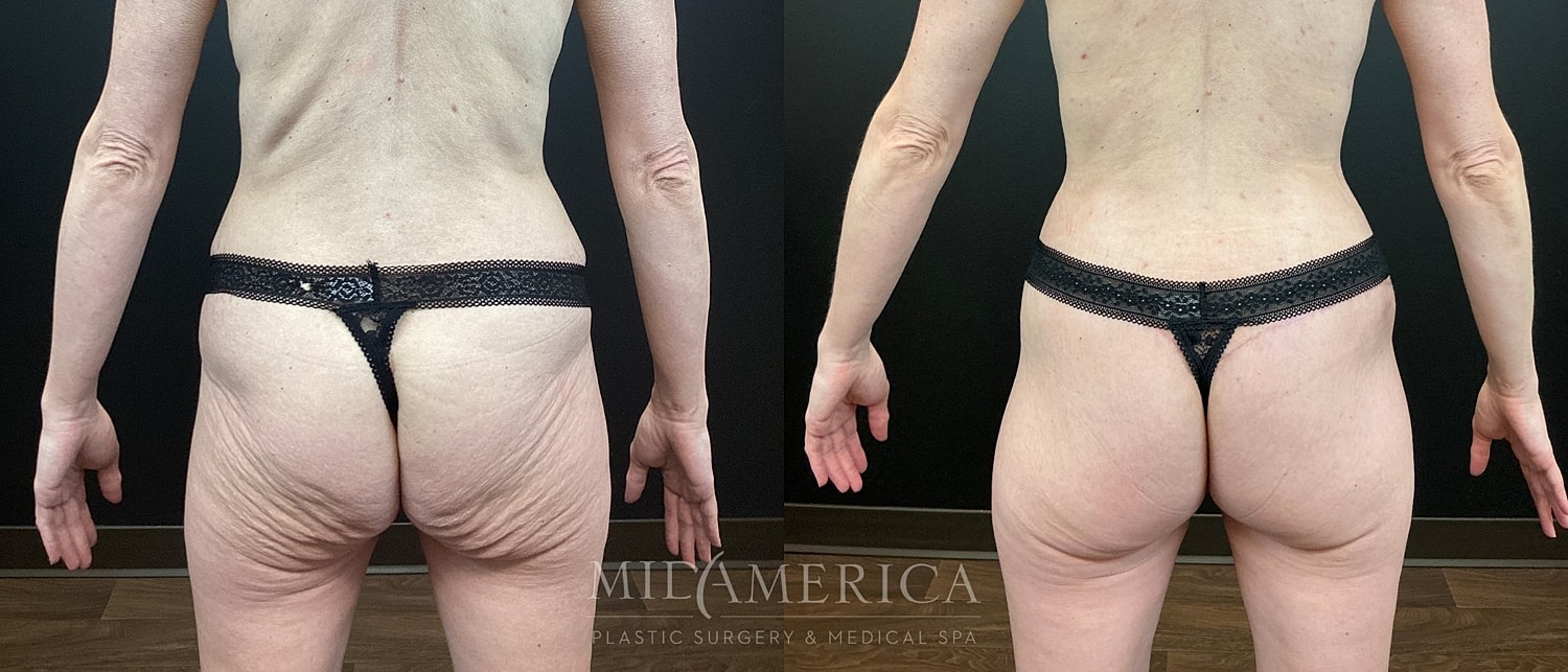 Belt Lipectomy  Before & After