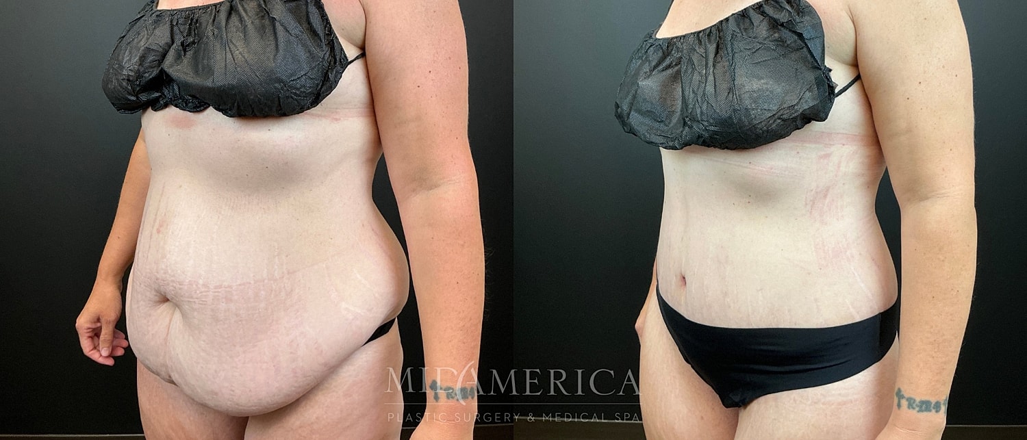 Belt Lipectomy  Before & After