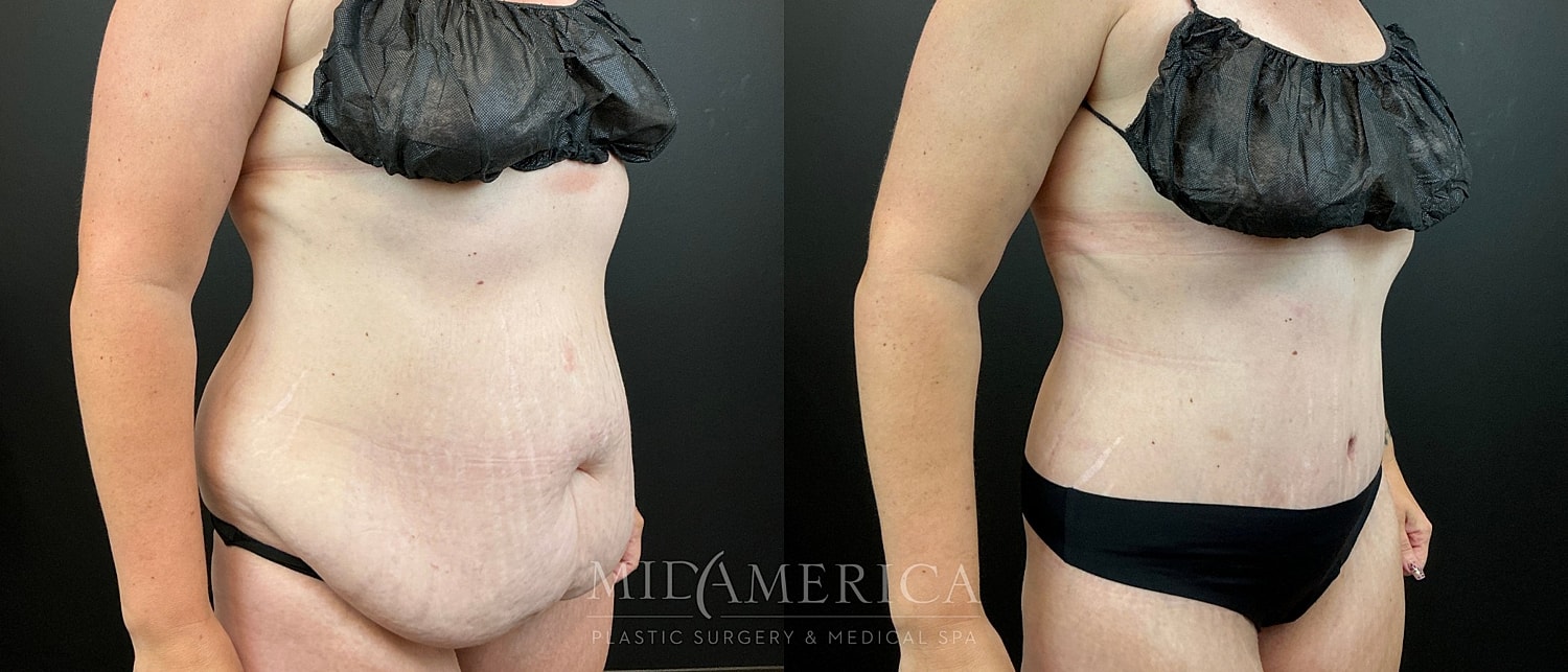 Belt Lipectomy  Before & After