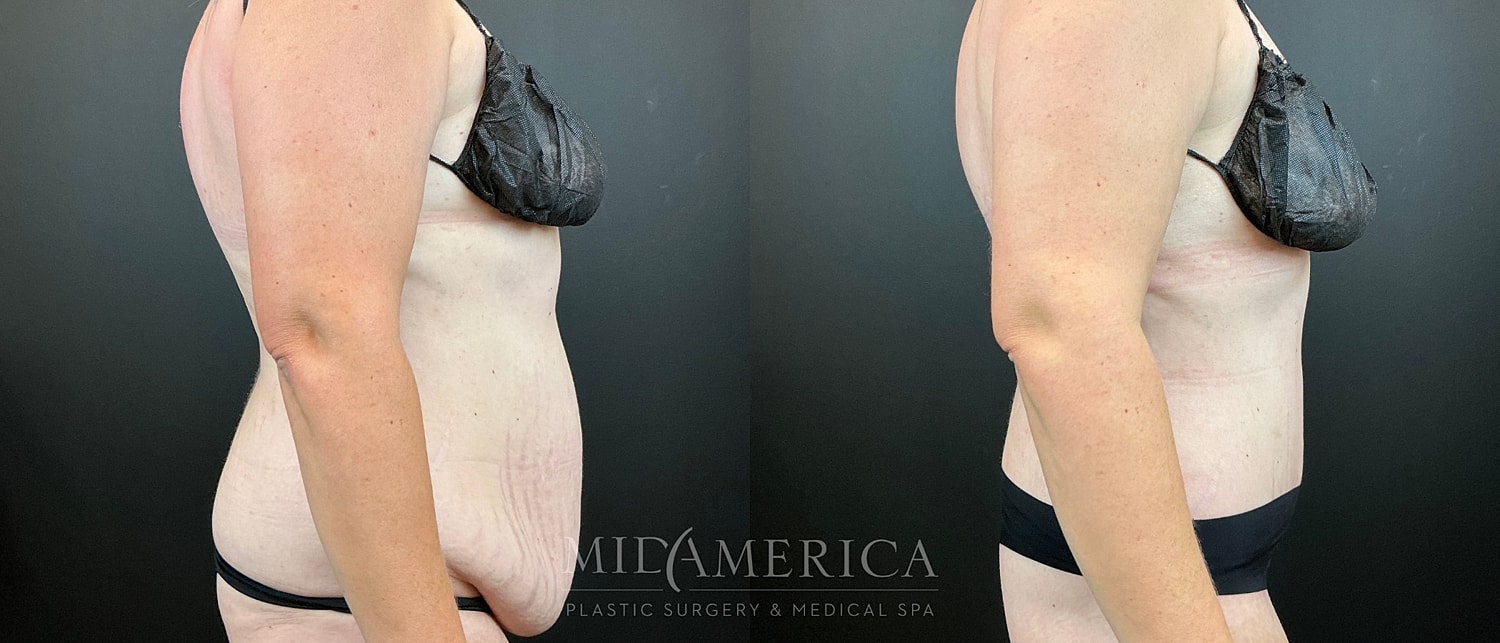 Belt Lipectomy  Before & After