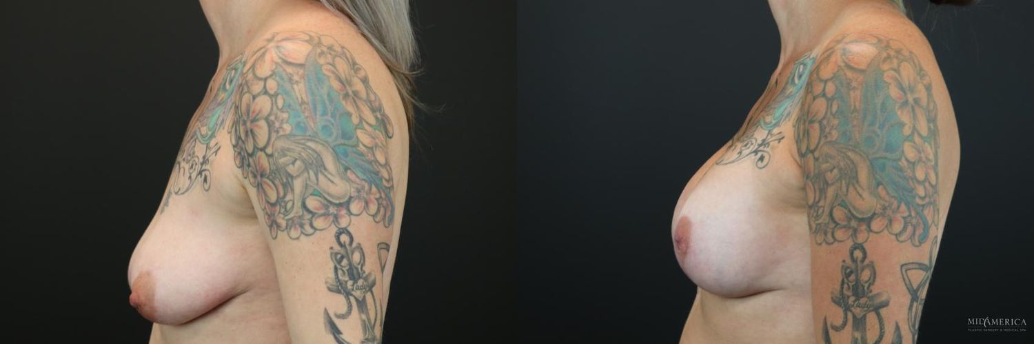 Breast Augmentation & Lift Before & After