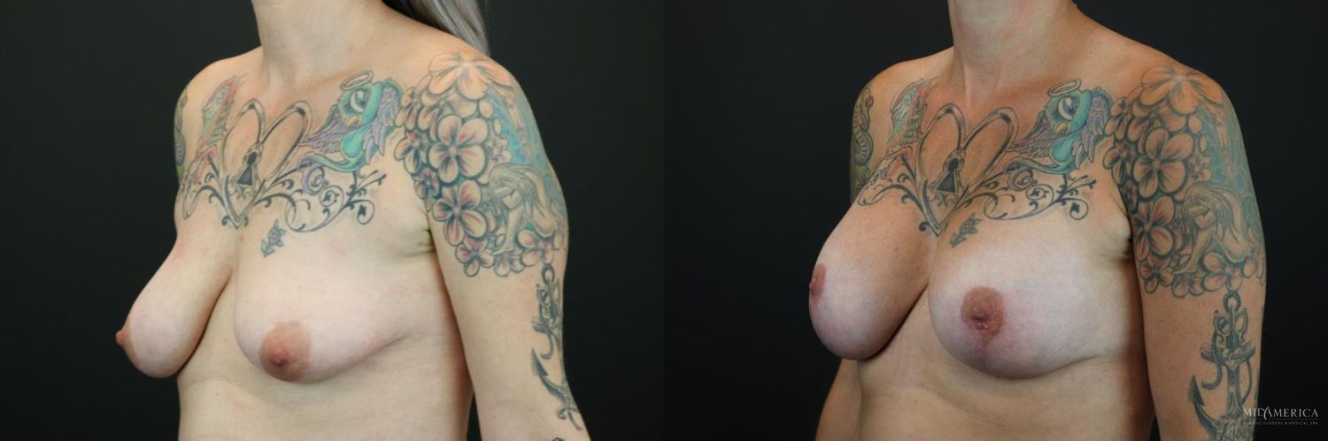 Breast Augmentation & Lift Before & After