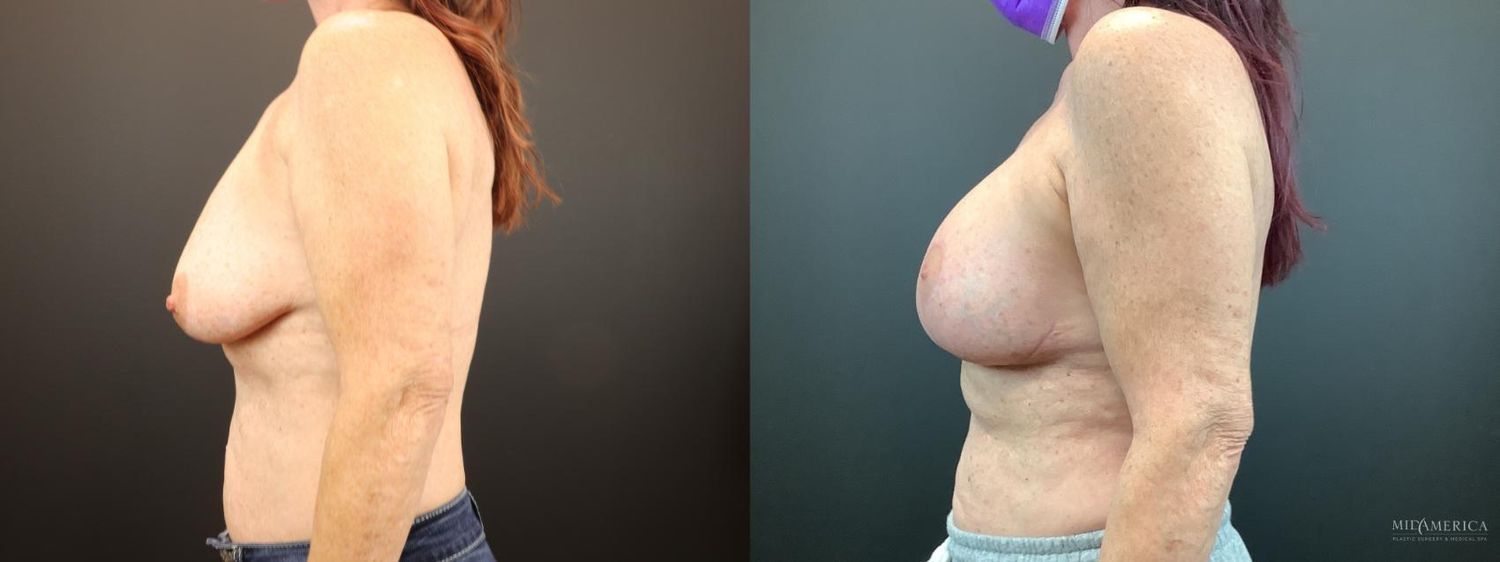 Breast Augmentation & Lift Before & After