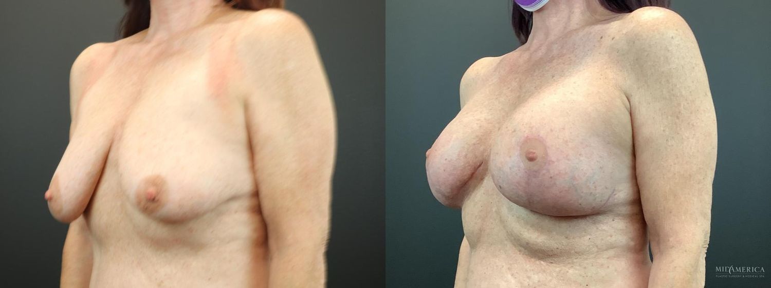 Breast Augmentation & Lift Before & After