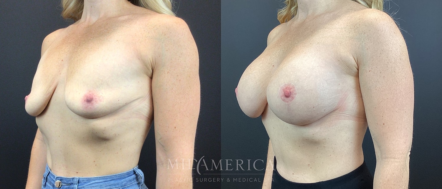 Breast Augmentation & Lift Before & After