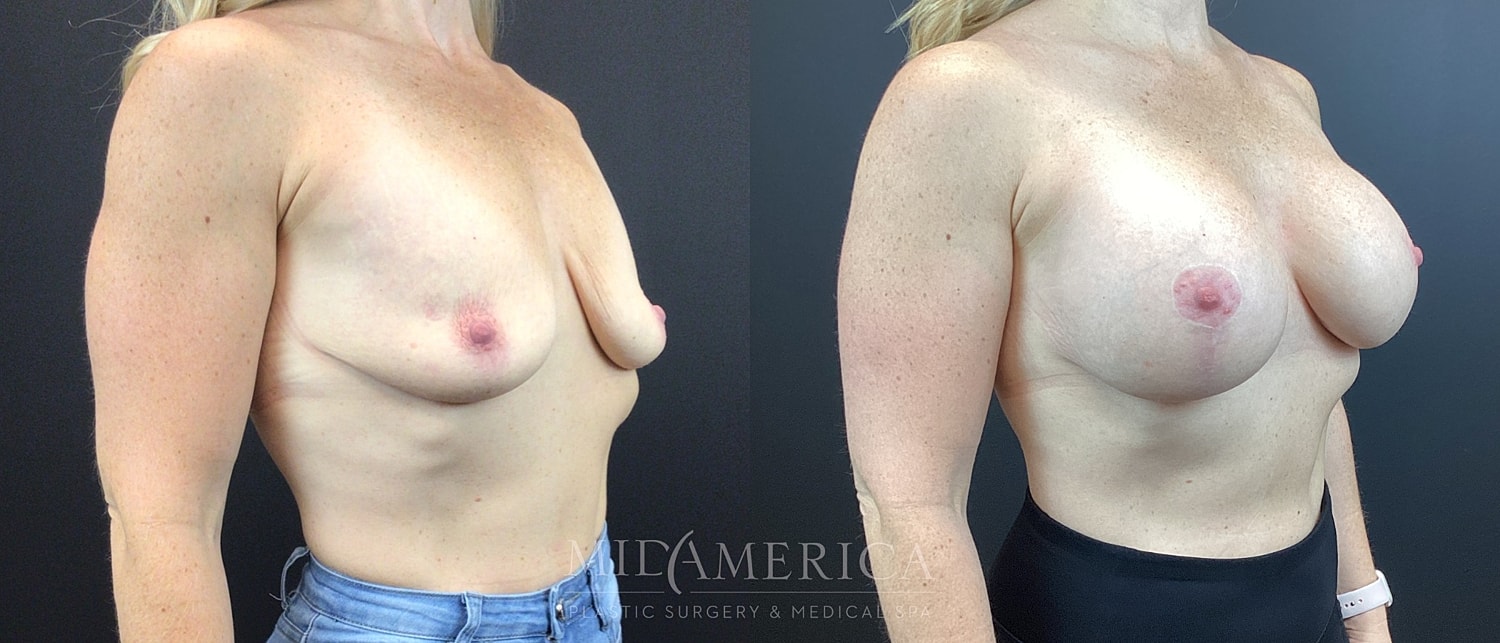 Breast Augmentation & Lift Before & After