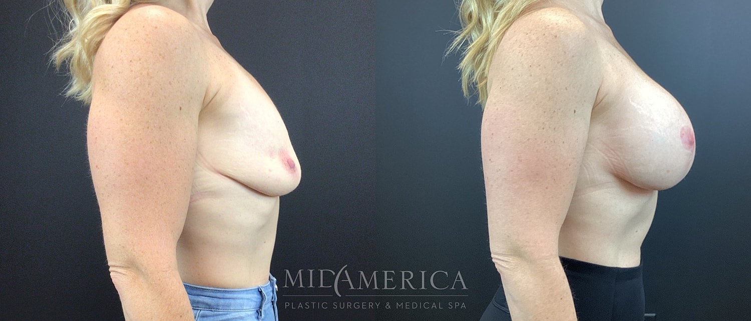 Breast Augmentation & Lift Before & After