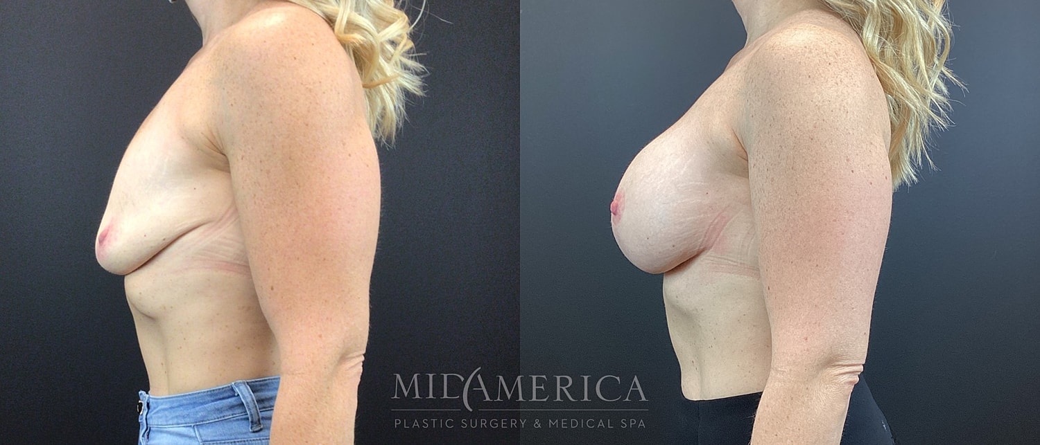 Breast Augmentation & Lift Before & After