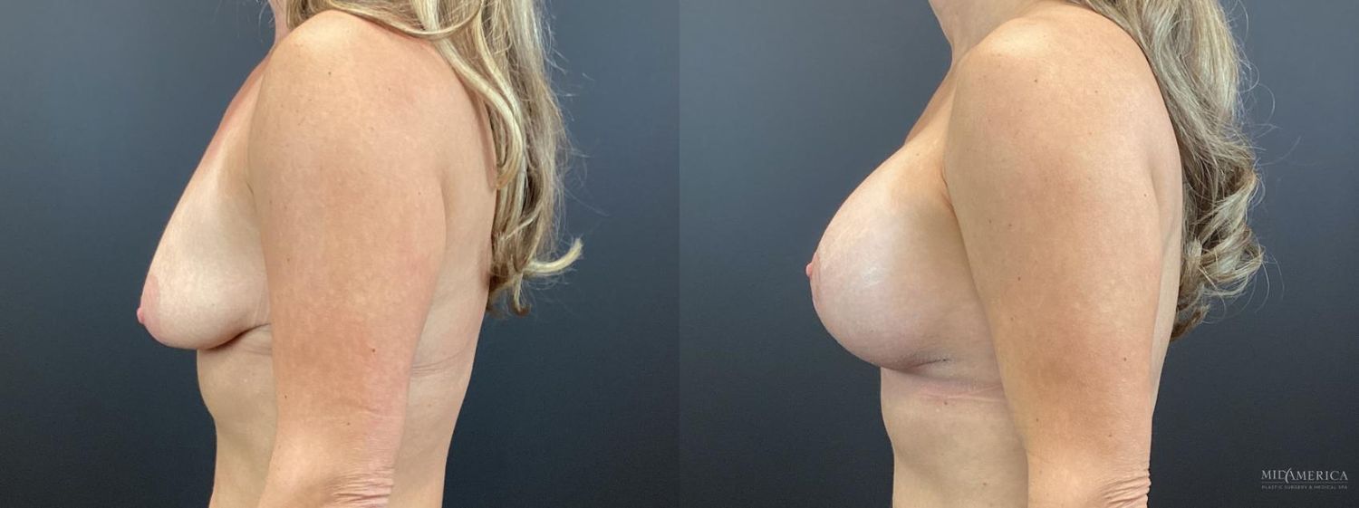 Breast Augmentation & Lift Before & After