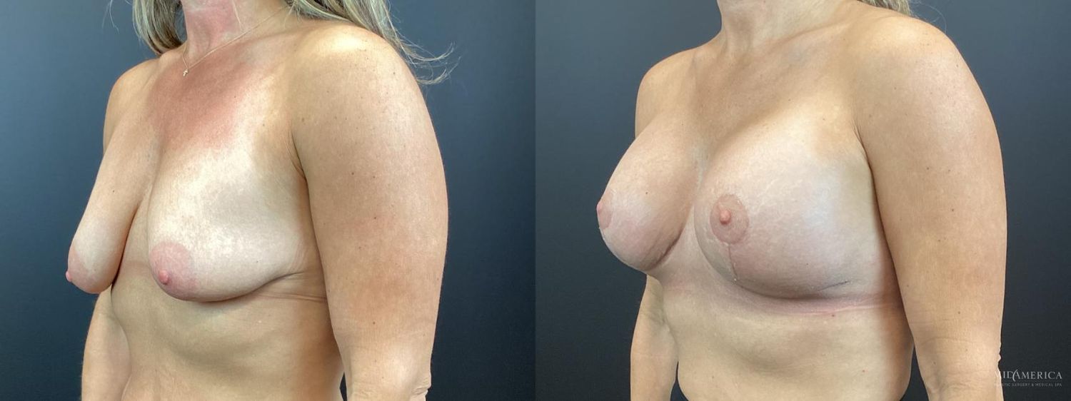 Breast Augmentation & Lift Before & After