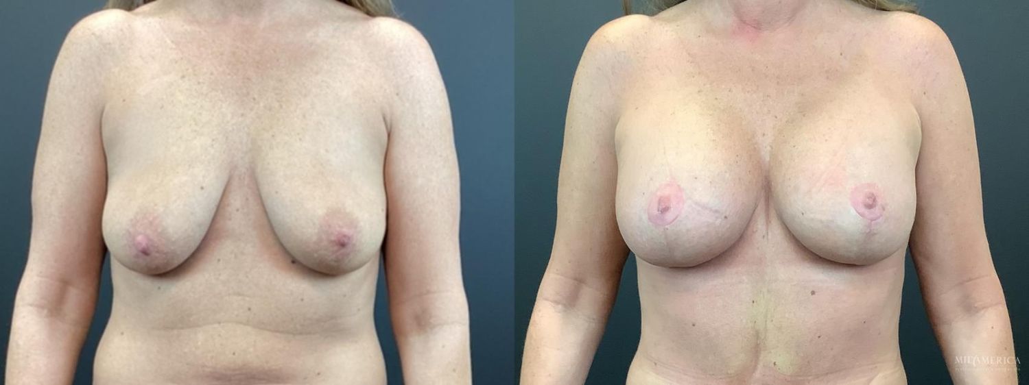 Breast Augmentation & Lift Before & After