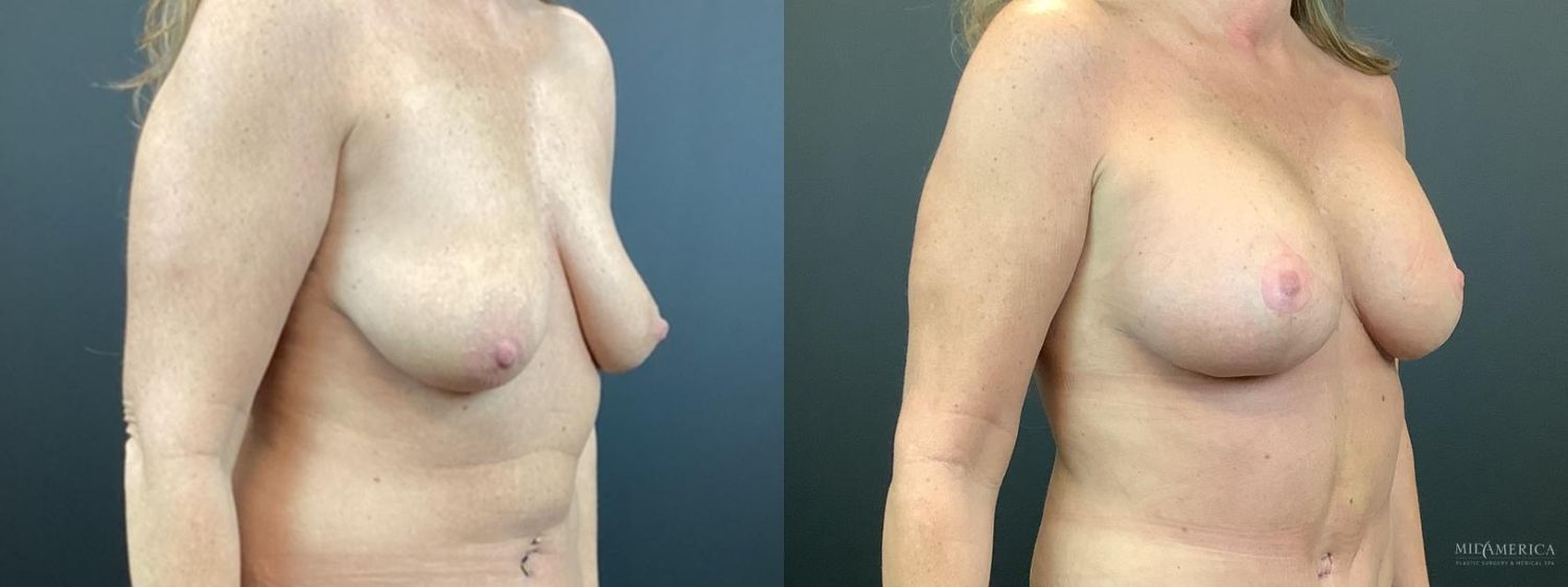Breast Augmentation & Lift Before & After
