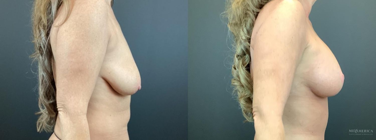 Breast Augmentation & Lift Before & After