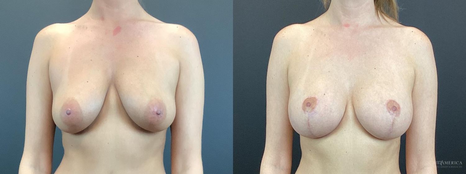 Breast Augmentation & Lift Before & After