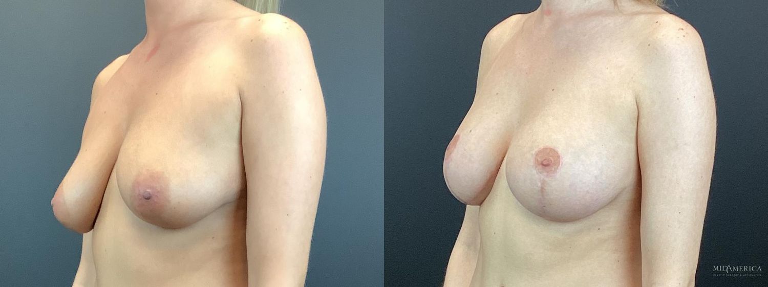 Breast Augmentation & Lift Before & After