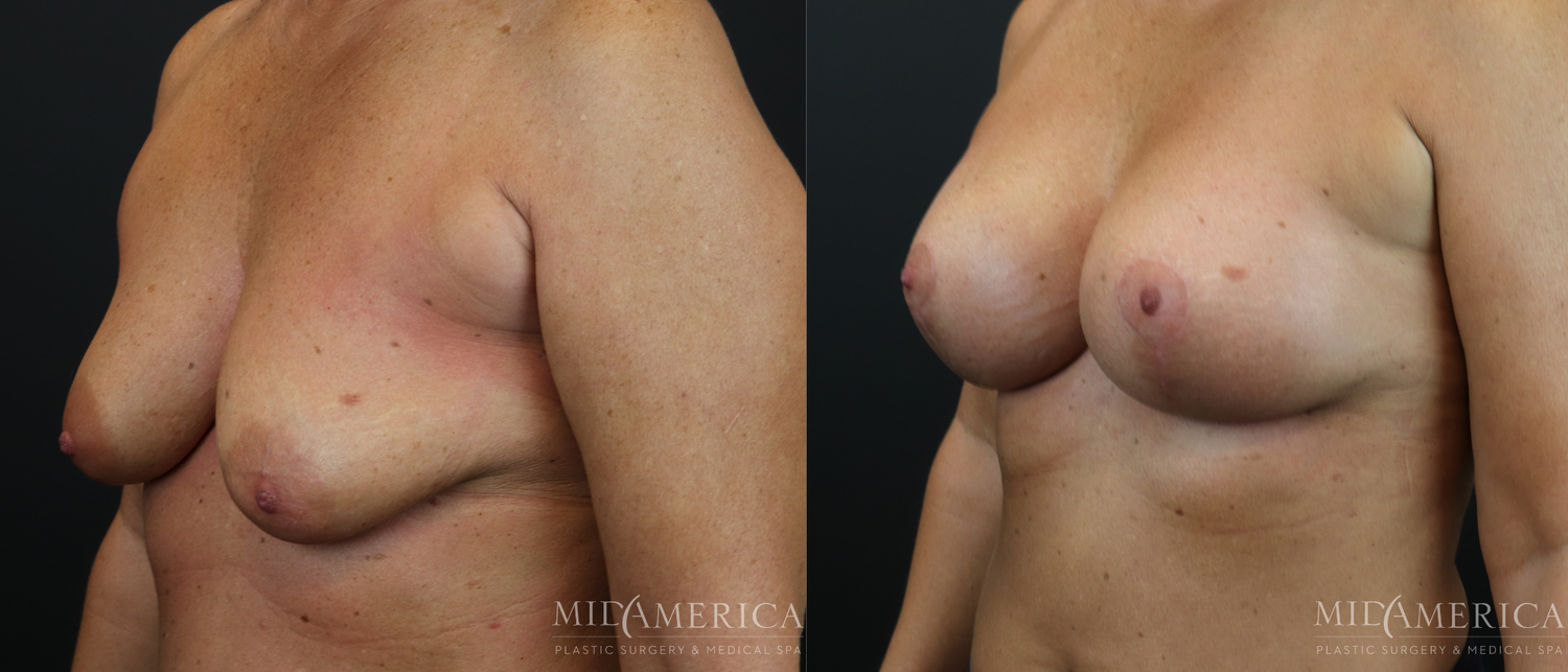 Breast Augmentation & Lift Before & After
